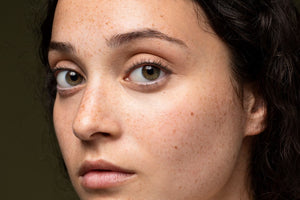Portrait of a girl with dry skin